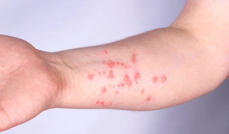 Cuiabá não registra casos de Mpox e mantém vigilância preventiva ativa